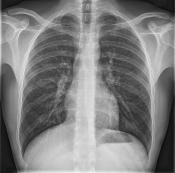 Diagnosis of thoracic osteochondrosis using radiography