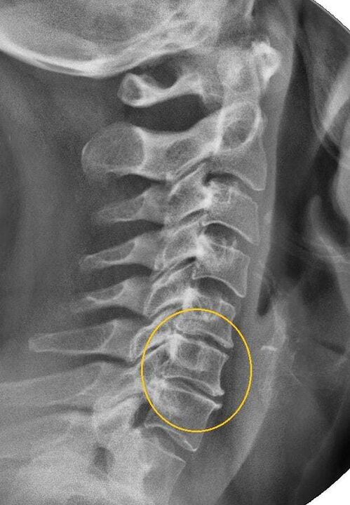 Osteochondral disease