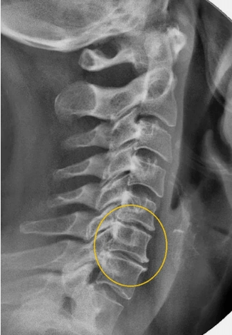Osteochondral bone marrow disease on X-ray