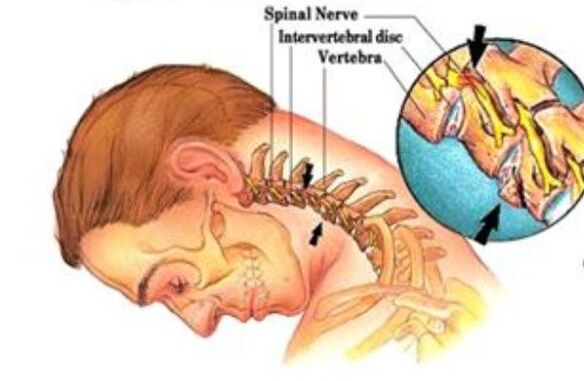 Neck bone and chondropathy