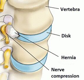 Osteochondral disease in the cervical area