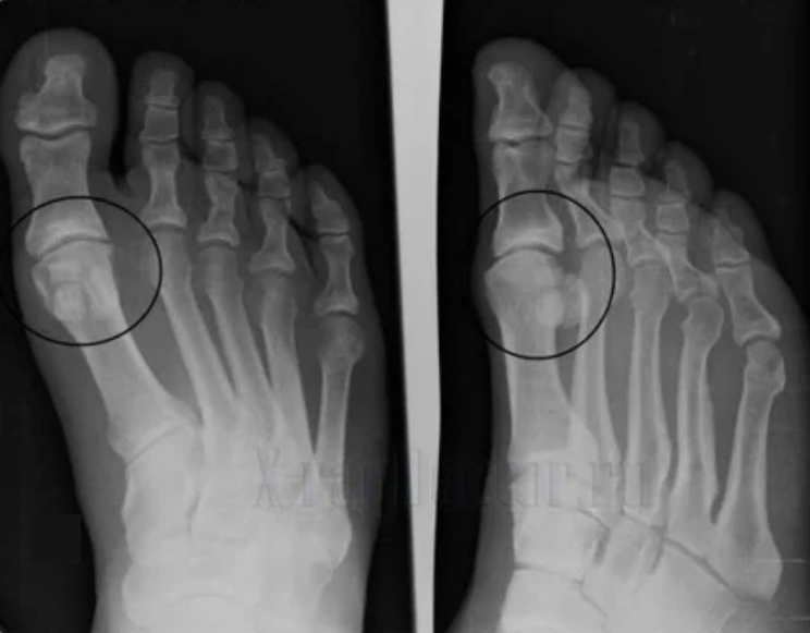 Diagnosis of arthritis