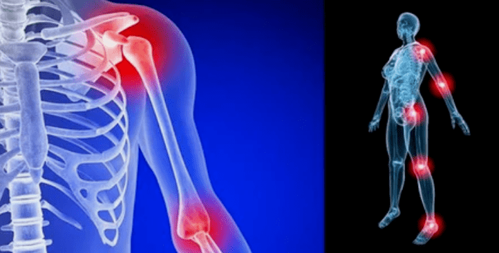 Joint limb deformation