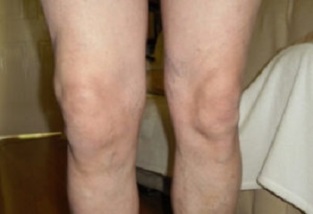 The performance of knee arthritis (1)