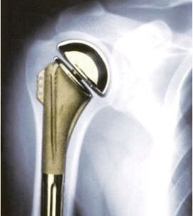 joint replacement surgery