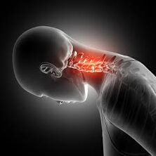cervical osteochondrosis