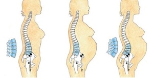 Stages of development of lumbar osteochondrosis