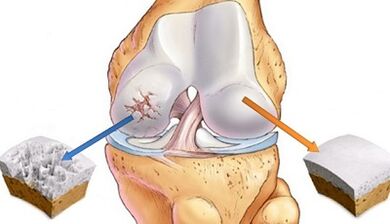 Causes of joint arthritis