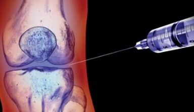 How to treat joint arthritis