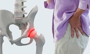 Causes of hip arthritis