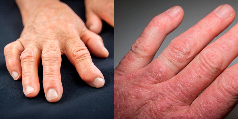 Hand rheumatoid arthritis and psoriatic arthritis