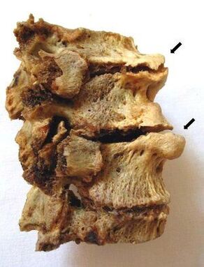 Sections of vertebrae affected by osteochondrosis