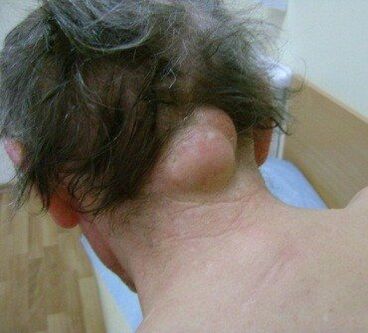 Tumor is the cause of neck pain