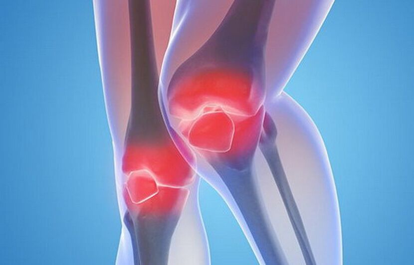 Knee arthropathy