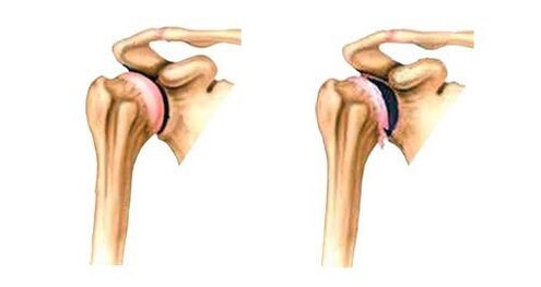 Health and Joints Shoulder Joints