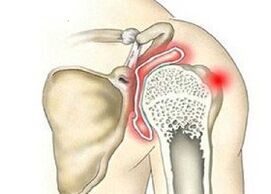 Shoulder joint destruction and arthropathy