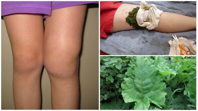 Herbal Dressings for Knee Osteoarthritis