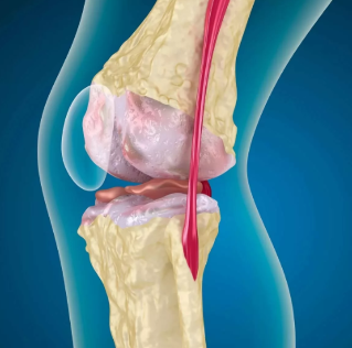 Osteoarthritis of the knee