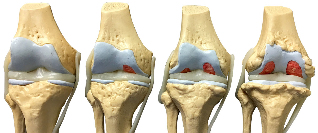 the degree of osteoarthritis