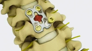 the surgical treatment of degenerative disc disease